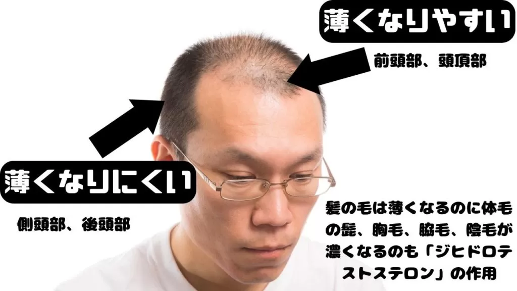 薄毛になりやすい部分と薄毛になりにくい部分