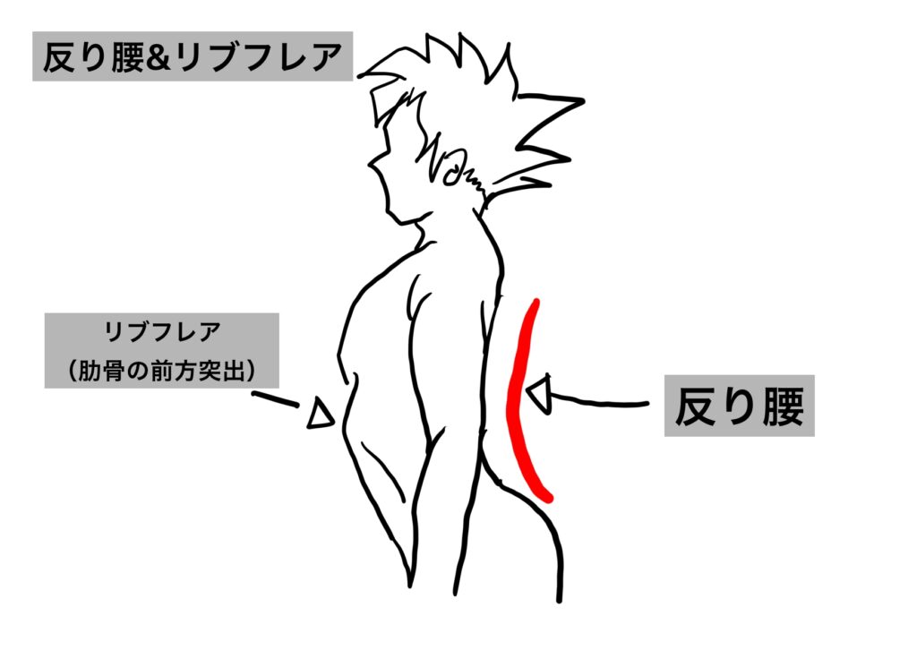 反り腰とリブフレアの図